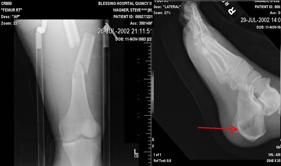 A shattered heel and a femur in three pieces kept me off the bike for only a few months.